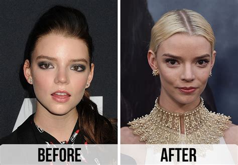 anya taylor-joy surgery|Fans Worried About Anya Taylor